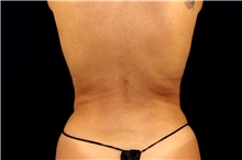 Liposuction After Photo by Landon Pryor, MD, FACS; Rockford, IL - Case 43031