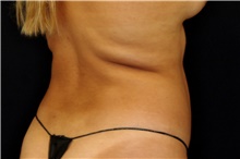 Liposuction Before Photo by Landon Pryor, MD, FACS; Rockford, IL - Case 43031