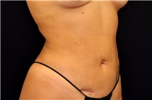 Liposuction After Photo by Landon Pryor, MD, FACS; Rockford, IL - Case 43031