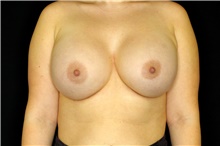 Breast Augmentation After Photo by Landon Pryor, MD, FACS; Rockford, IL - Case 43032