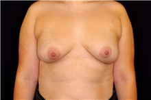 Breast Augmentation Before Photo by Landon Pryor, MD, FACS; Rockford, IL - Case 43032