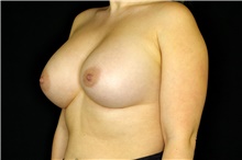 Breast Augmentation After Photo by Landon Pryor, MD, FACS; Rockford, IL - Case 43032