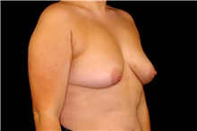 Breast Augmentation Before Photo by Landon Pryor, MD, FACS; Rockford, IL - Case 43032