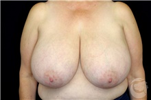 Breast Reduction Before Photo by Landon Pryor, MD, FACS; Rockford, IL - Case 43034