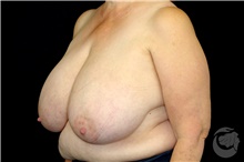Breast Reduction Before Photo by Landon Pryor, MD, FACS; Rockford, IL - Case 43034
