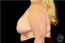 Breast Reduction After Photo by Landon Pryor, MD, FACS; Rockford, IL - Case 43034