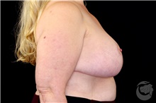 Breast Reduction After Photo by Landon Pryor, MD, FACS; Rockford, IL - Case 43034