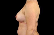 Breast Augmentation After Photo by Landon Pryor, MD, FACS; Rockford, IL - Case 43036