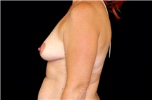 Breast Augmentation Before Photo by Landon Pryor, MD, FACS; Rockford, IL - Case 43036