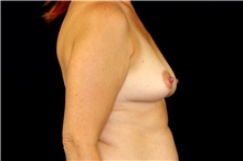 Breast Augmentation Before Photo by Landon Pryor, MD, FACS; Rockford, IL - Case 43036
