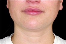 Nonsurgical Fat Reduction After Photo by Landon Pryor, MD, FACS; Rockford, IL - Case 43037