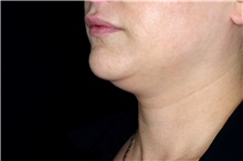 Nonsurgical Fat Reduction Before Photo by Landon Pryor, MD, FACS; Rockford, IL - Case 43037