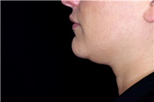 Nonsurgical Fat Reduction Before Photo by Landon Pryor, MD, FACS; Rockford, IL - Case 43037