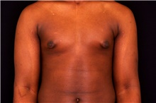 Male Breast Reduction Before Photo by Landon Pryor, MD, FACS; Rockford, IL - Case 43038