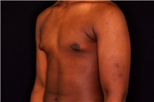 Male Breast Reduction Before Photo by Landon Pryor, MD, FACS; Rockford, IL - Case 43038