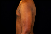 Male Breast Reduction After Photo by Landon Pryor, MD, FACS; Rockford, IL - Case 43038
