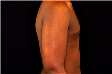 Male Breast Reduction After Photo by Landon Pryor, MD, FACS; Rockford, IL - Case 43038