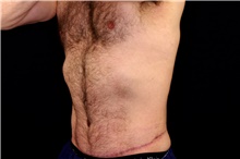 Tummy Tuck After Photo by Landon Pryor, MD, FACS; Rockford, IL - Case 43039