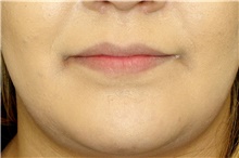 Injectable Fillers Before Photo by Landon Pryor, MD, FACS; Rockford, IL - Case 43040