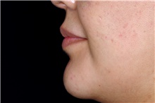 Injectable Fillers After Photo by Landon Pryor, MD, FACS; Rockford, IL - Case 43040