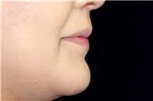 Injectable Fillers Before Photo by Landon Pryor, MD, FACS; Rockford, IL - Case 43040