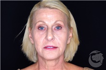 Brow Lift After Photo by Landon Pryor, MD, FACS; Rockford, IL - Case 43041
