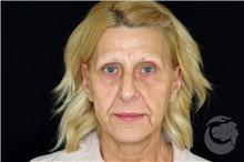 Brow Lift Before Photo by Landon Pryor, MD, FACS; Rockford, IL - Case 43041
