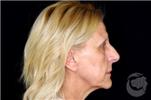 Brow Lift Before Photo by Landon Pryor, MD, FACS; Rockford, IL - Case 43041