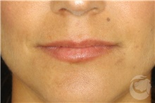Injectable Fillers Before Photo by Landon Pryor, MD, FACS; Rockford, IL - Case 43042
