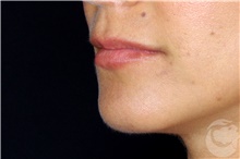 Injectable Fillers Before Photo by Landon Pryor, MD, FACS; Rockford, IL - Case 43042