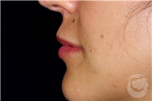 Injectable Fillers After Photo by Landon Pryor, MD, FACS; Rockford, IL - Case 43042