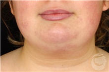 Liposuction Before Photo by Landon Pryor, MD, FACS; Rockford, IL - Case 43043