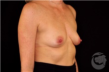 Breast Implant Removal Before Photo by Landon Pryor, MD, FACS; Rockford, IL - Case 43044