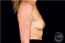 Breast Implant Removal Before Photo by Landon Pryor, MD, FACS; Rockford, IL - Case 43044