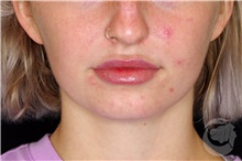 Injectable Fillers After Photo by Landon Pryor, MD, FACS; Rockford, IL - Case 43045