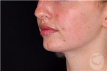 Injectable Fillers After Photo by Landon Pryor, MD, FACS; Rockford, IL - Case 43045