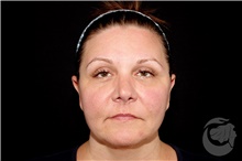 Thread Lift After Photo by Landon Pryor, MD, FACS; Rockford, IL - Case 43047