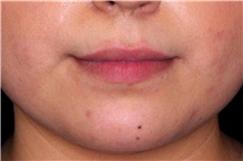 Injectable Fillers Before Photo by Landon Pryor, MD, FACS; Rockford, IL - Case 44093