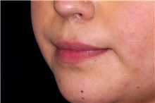 Injectable Fillers Before Photo by Landon Pryor, MD, FACS; Rockford, IL - Case 44093