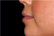 Injectable Fillers After Photo by Landon Pryor, MD, FACS; Rockford, IL - Case 44093