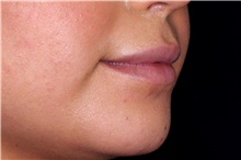 Injectable Fillers After Photo by Landon Pryor, MD, FACS; Rockford, IL - Case 44093