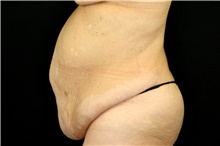 Tummy Tuck Before Photo by Landon Pryor, MD, FACS; Rockford, IL - Case 45008