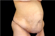 Tummy Tuck Before Photo by Landon Pryor, MD, FACS; Rockford, IL - Case 45008