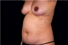 Tummy Tuck Before Photo by Landon Pryor, MD, FACS; Rockford, IL - Case 45010