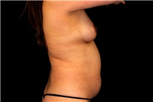 Tummy Tuck Before Photo by Landon Pryor, MD, FACS; Rockford, IL - Case 45010