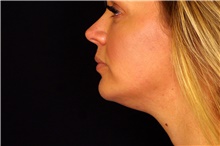 Injectable Fillers After Photo by Landon Pryor, MD, FACS; Rockford, IL - Case 45012
