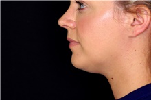 Injectable Fillers Before Photo by Landon Pryor, MD, FACS; Rockford, IL - Case 45012