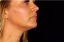 Injectable Fillers After Photo by Landon Pryor, MD, FACS; Rockford, IL - Case 45012