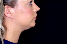 Injectable Fillers Before Photo by Landon Pryor, MD, FACS; Rockford, IL - Case 45012