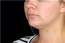 Nonsurgical Fat Reduction Before Photo by Landon Pryor, MD, FACS; Rockford, IL - Case 45013